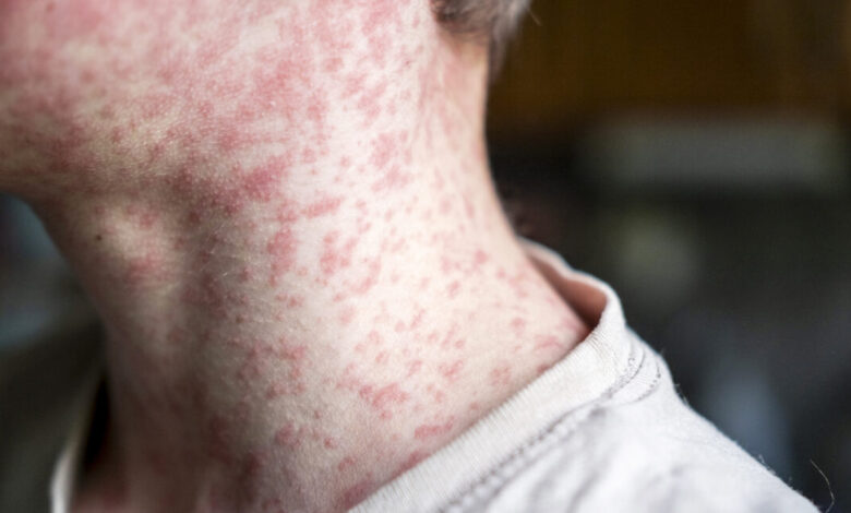 Measles outbreak in undervaccinated Texas area doubles—again Measles outbreak in undervaccinated Texas area doubles—again