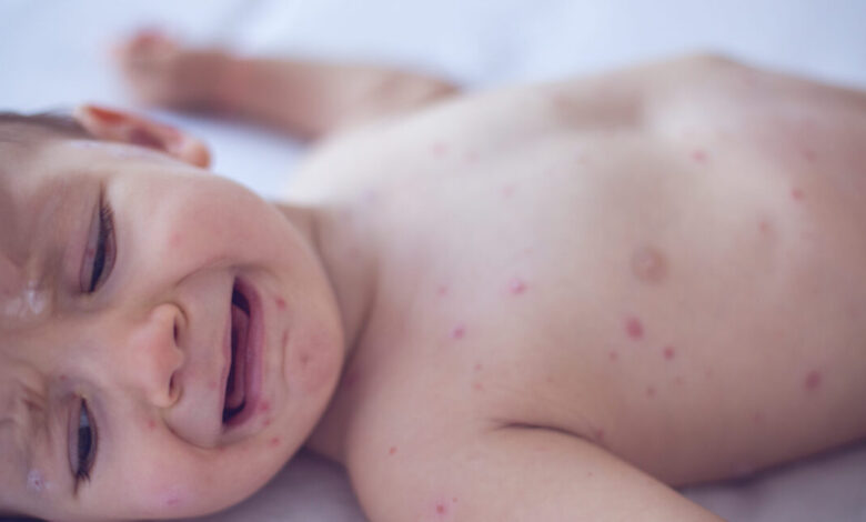 US measles outlook is so bad health experts call for updating vaccine guidance US measles outlook is so bad health experts call for updating vaccine guidance