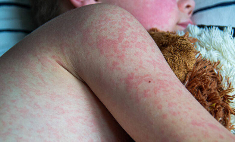 With over 900 US measles cases so far this year, things are looking bleak With over 900 US measles cases so far this year, things are looking bleak